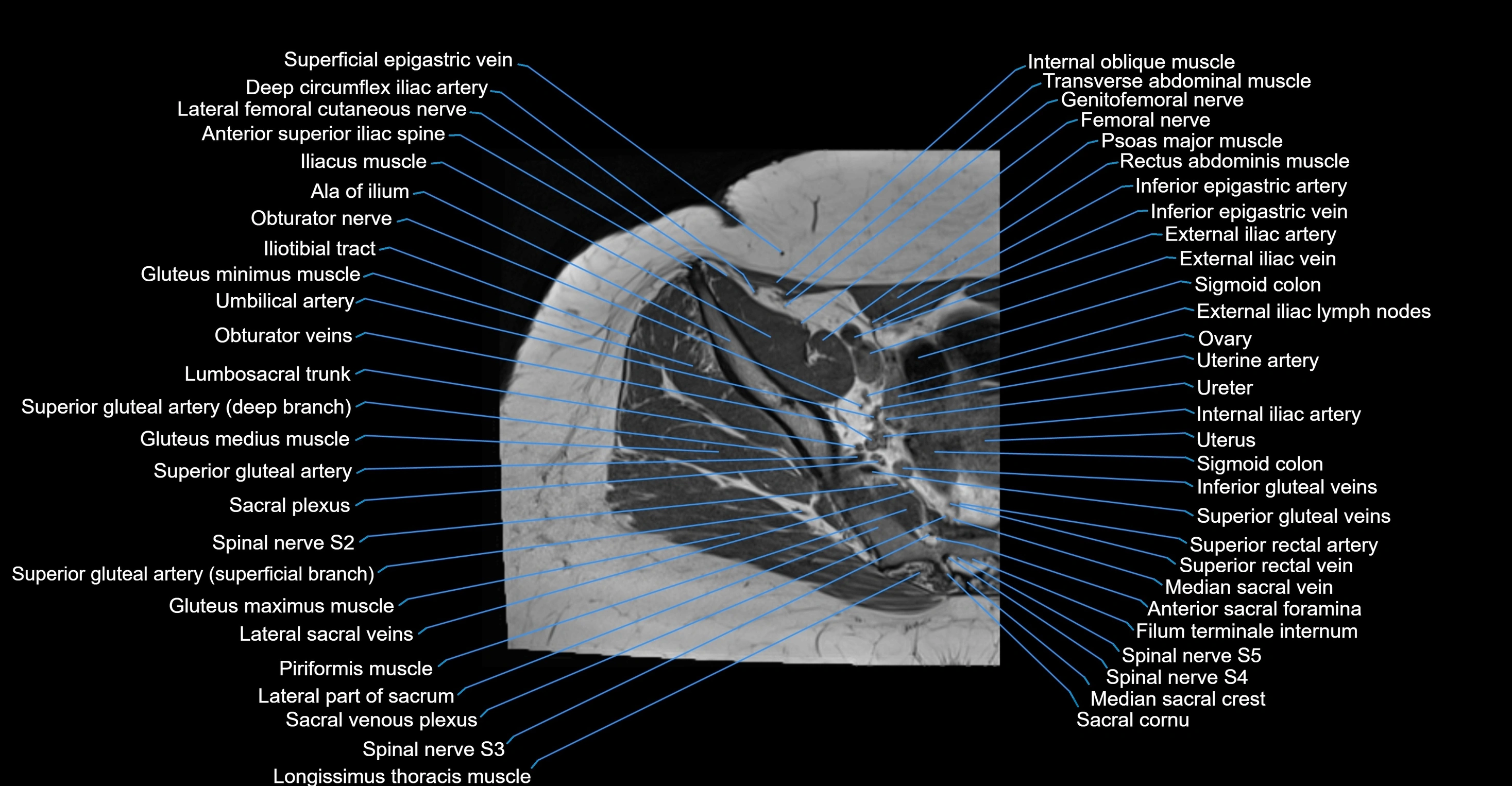 MRI hip axial cross sectional anatomy 3T 3D  radiology  anatomy image-img-00001-00008.webp